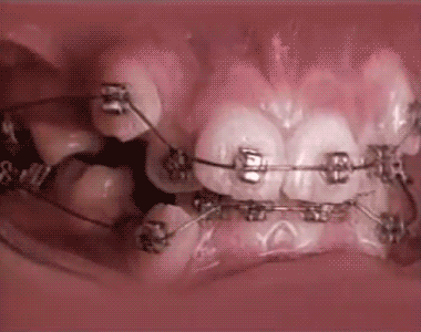 歯列矯正