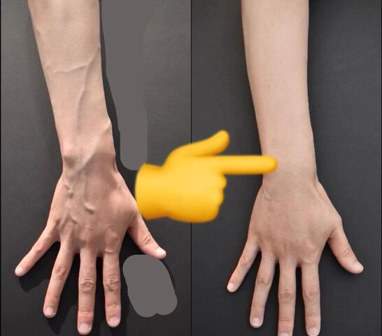 ハンドペイン手術