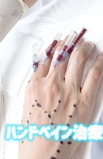 ハンドペイン手術